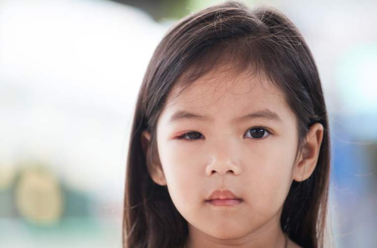 눈 다래끼 - 아이부터 어른까지 꼭 알아야 할 모든 것